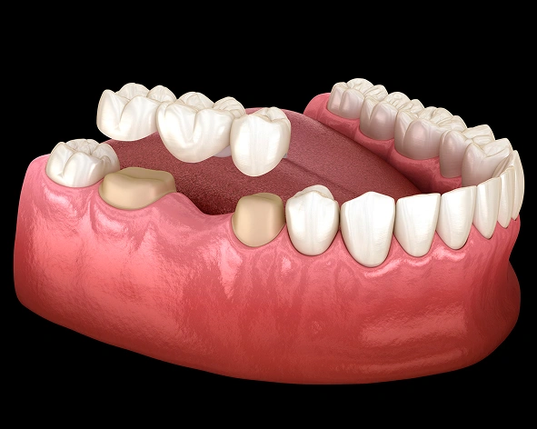 dental bridges in hagerstown