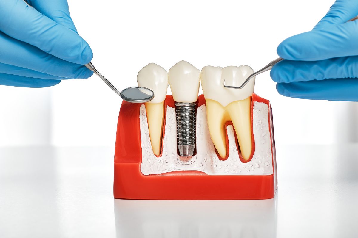 bone grafting for dental implants