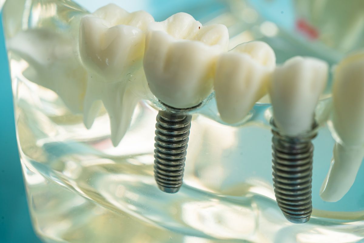 care for your dental implants