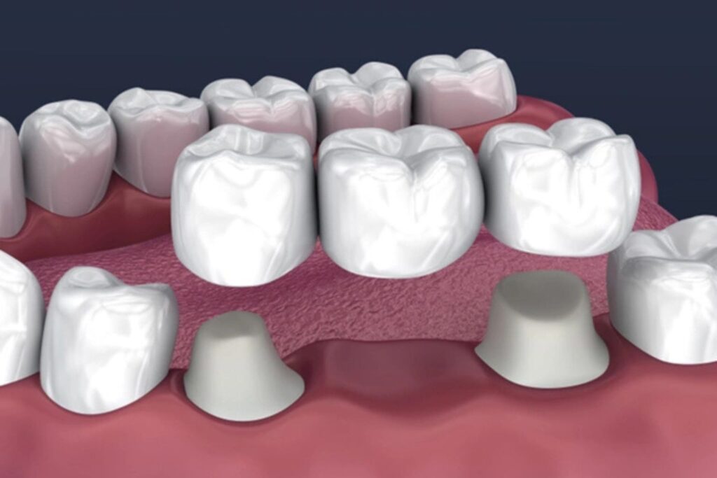 dental bridges
