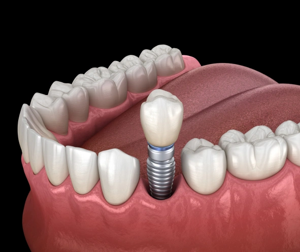 implant dentistry in hagerstown