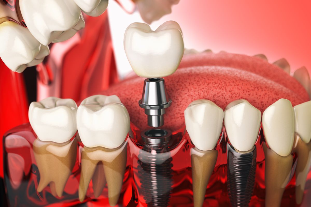 recovery tips after dental implant surgery